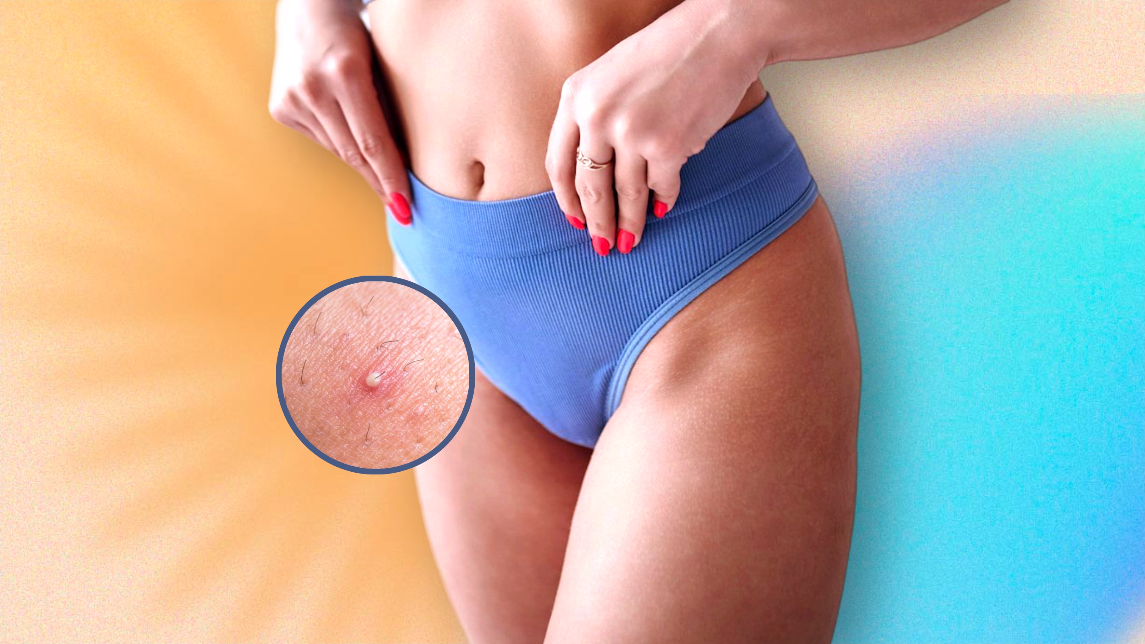 вросший волос, убрать вросший волос, депиляция, шугаринг, бритье, как брить зонц бикини, зона бикини, глубокое бикини, воспаление после бритья